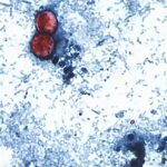 Cyclospora outbreak tied to lettuce now involves 20 US states