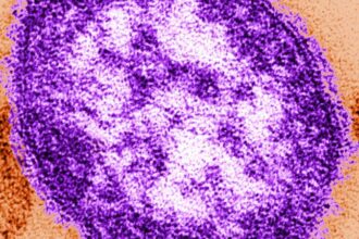 Measles: Adult woman dies amid growing Pennsylvania outbreak
