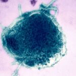 Measles: Pennsylvania reports fourth death
